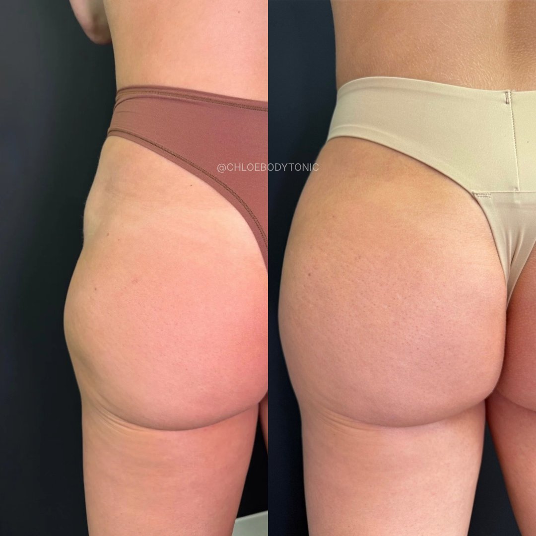 Before and after photos of a Body Tonic RX patient in Austin showing added glute volume, improved projection, and smoother contour following non-surgical BBL filler with biostimulatory injectables