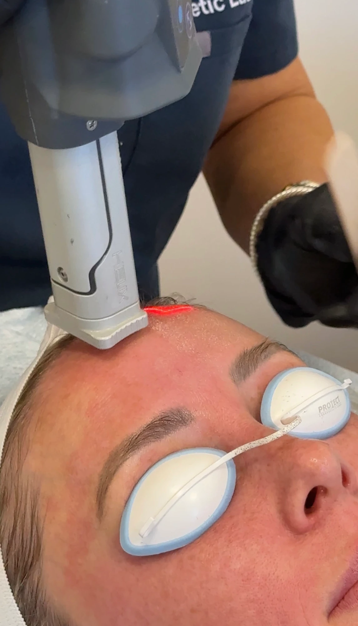 CoolPeel CO₂ resurfacing at Body Tonic RX Austin