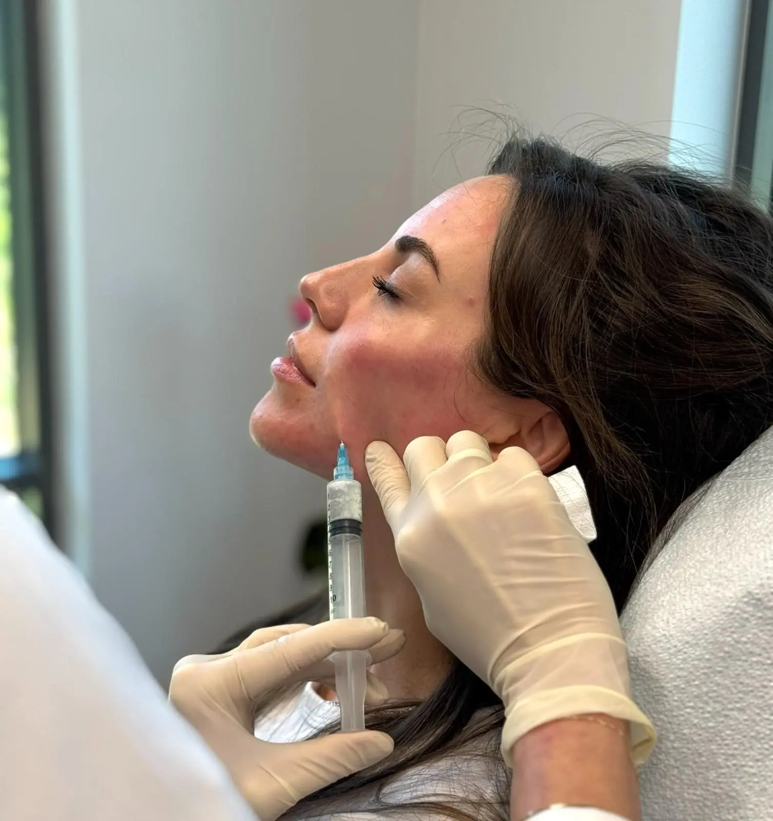 Sculptra collagen biostimulator results at Body Tonic RX Austin