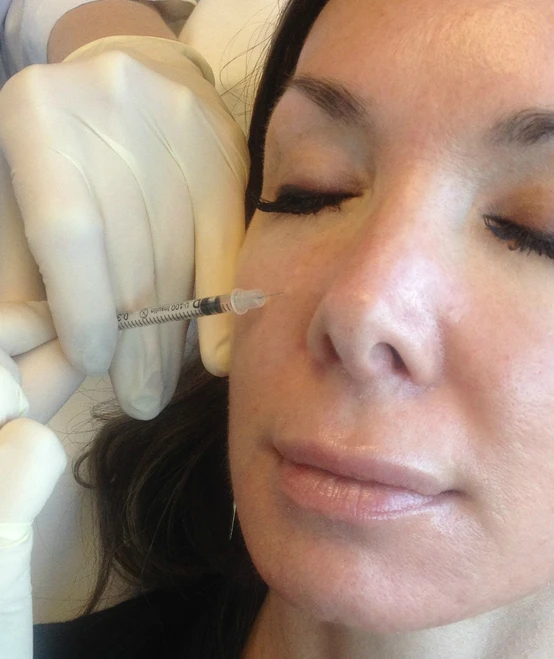 Airbrush with Botox: Micro Botox injections can diminish oily skin and shrink pores