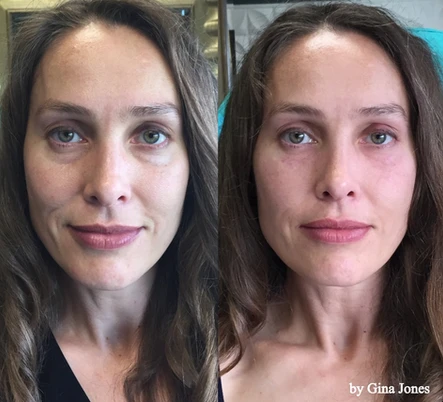 All About the Eyes: Treating Above the Mask!