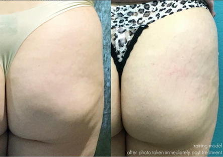 All the Right Moves: Sculptra and Kybella Treatments for Shaping and Augmenting in All the Right Pla
