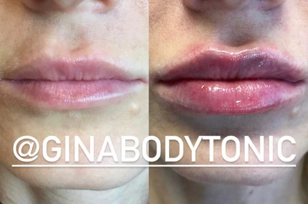 Appendectomy, Dreams and Lip Injections