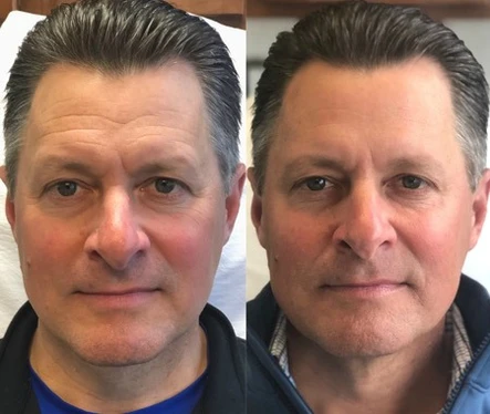 Botox Cosmetic: Focus on Injections for Men