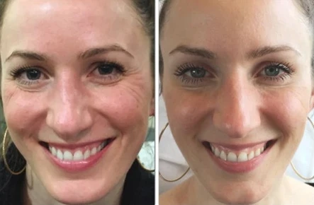 Botox for Better Skin Quality