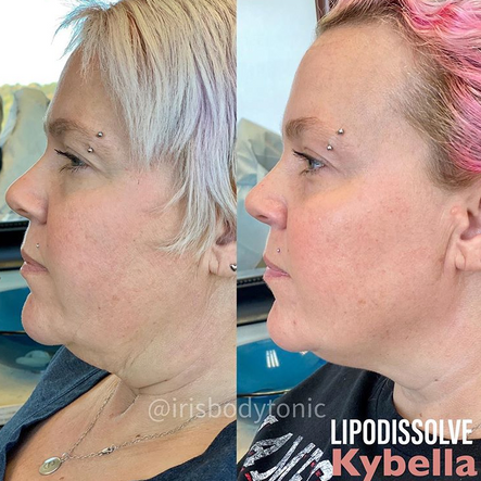 Chin Up! Kybella for Dissolving “Double Chin”