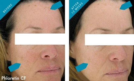 Fall is Here: Let’s Fry That Sun Damage