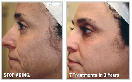 Forever Young BBL: Proven to Reverse the Signs of Aging