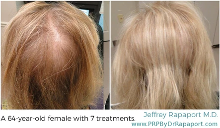 How to Not Be Bald: PRP for Hair Restoration