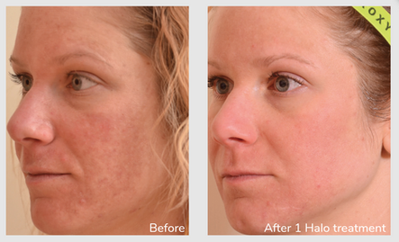 I Had the Halo Laser Treatment, Here’s What Happened
