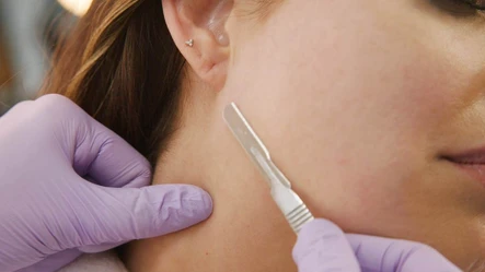 Is Dermaplaning At-Home the Same as a Professional Treatment?