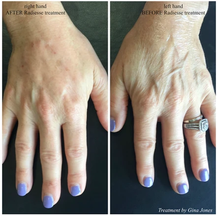 It’s Handled! Treatment Options for Hand Beautification