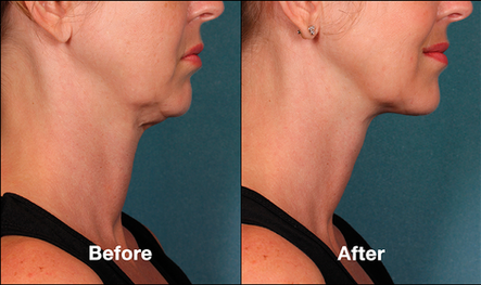 Just in Time for Thanksgiving…No More Turkey Waddle with Kybella (and some free Voluma!)