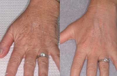 Micro Laser Peel Treatment: Get Your Hands Looking Like You’re in College Again