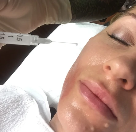 MicroSculpt! Micropen + Topical Sculptra for Intense Collagen Stimulation