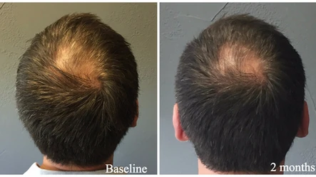 PRP: A Real Hair Miracle