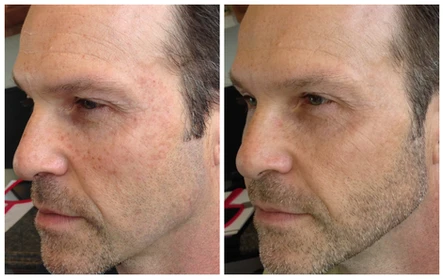 Part One: Injections + Skincare for Men