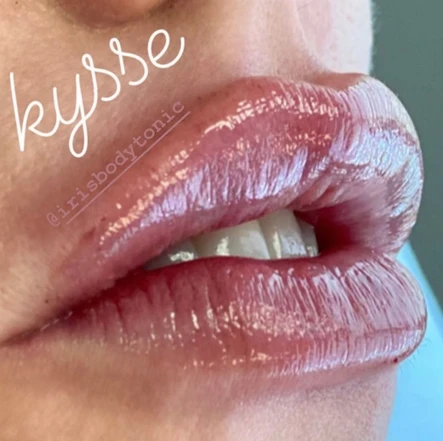 Post-Quarantine Goodies: A New Lip Filler and a Deep Chemical Peel