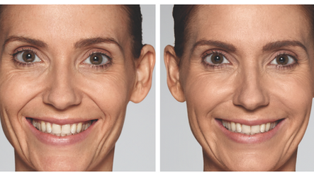 Redefyning Beauty? Welcome the Newest Fillers: Restylane Refyne and Defyne