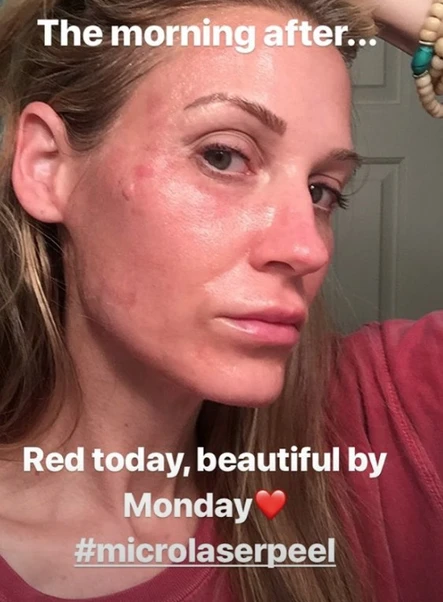 Shedding Skin: The Micro Laser Peel