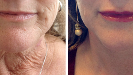 Subtlety in Beauty: Yes, We All Have Filler