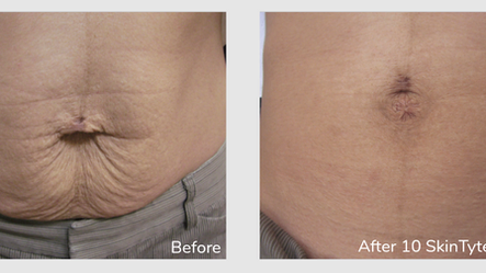 SkinTyte is Coming This Month! Tighten Everything From Your Eyes to Your Knees!