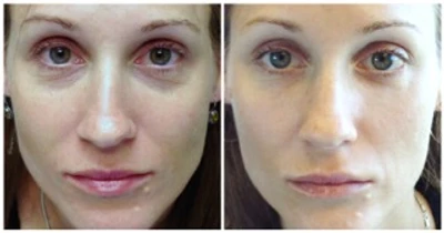 Restylane for Rested Eyes: tear trough injections for improving dark circles and under-eye puffiness
