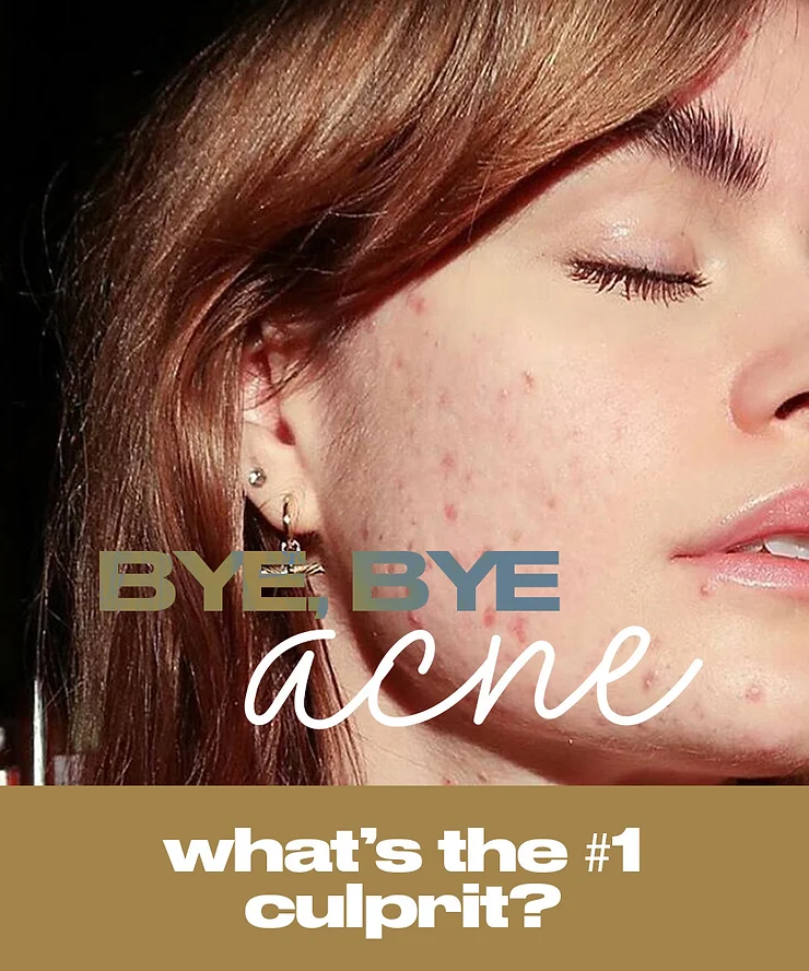 BYE, BYE STUBBORN ACNE