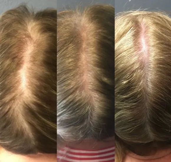 Get Growing: PRP for Hair Restoration