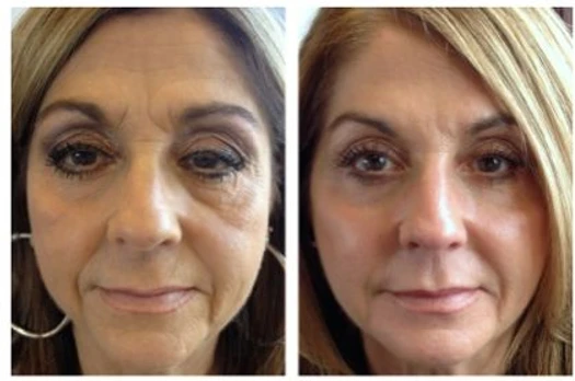 Liquid Facelift: the amazing results and instant gratification of a non-surgical facelift