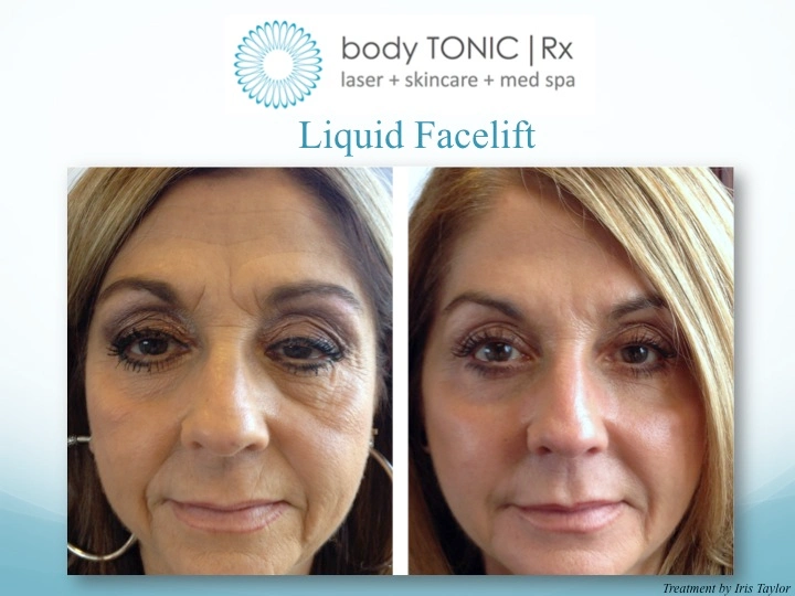 This is What a Liquid Facelift Looks Like