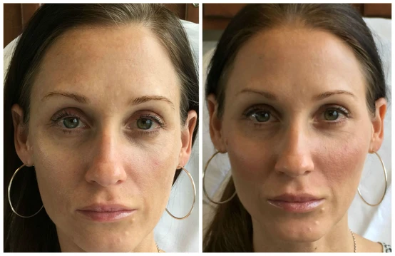 Sweet Cheeks! It Started as Marketing But Ended As Love: Restylane Lyft for Cheek Enhancement