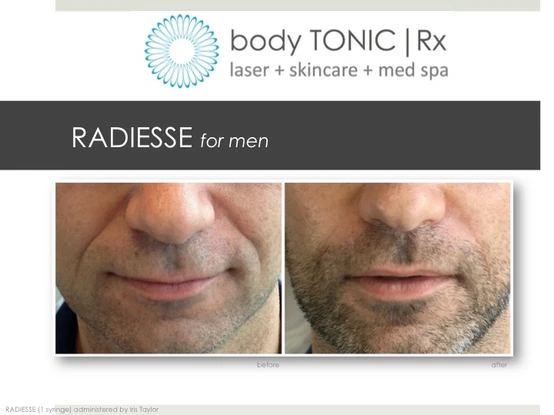 The Full Treatment: Radiesse for Hands, Cellulite, Earlobes and Face