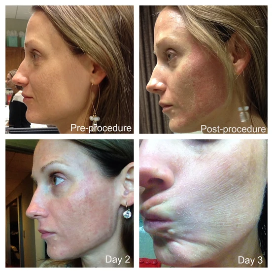 Whisper Chatter: A Diary of the Most Popular Laser Skin Treatment
