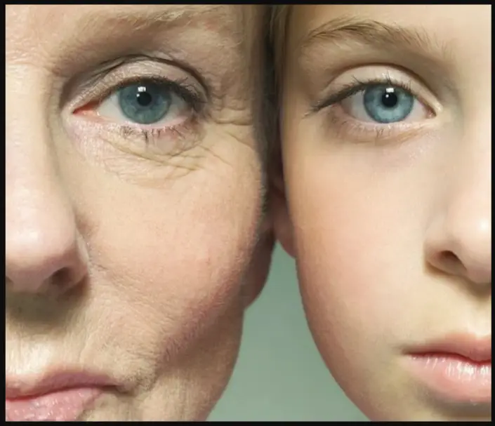 Turn Back Time? Optimal Correction With Dermal Filler