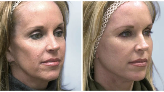 Spectacular Sculptra: Re-Grow Your Own Collagen with This Amazing Facial Volumizer
