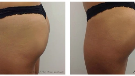 Vanquish Part Three: Body Contouring and the Beach