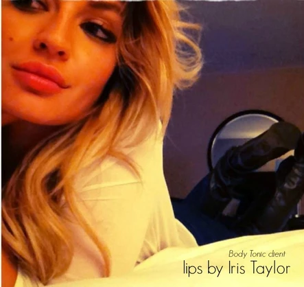 Filler Up! A Lesson in Dermal Fillers: Restylane, Perlane, Juvederm, Voluma, Belotero, Radiesse