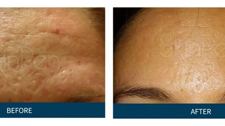 Best Treatments for Acne Scarring in Austin, TX | Body Tonic Medical Spa And Wellness