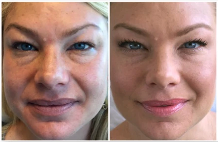Eat Your Way Out of Bruising and Swelling in Austin TX