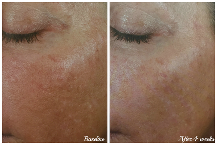Before and Afters of Better Skin in Austin TX