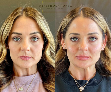 Fillers Botox in Austin, TX | Body Tonic Medical Spa And Wellness