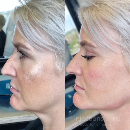 Trending Treatment Radiesse for Jawline in Austin, TX | Body Tonic Medical Spa And Wellness