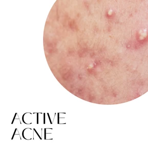 Body Tonic Medical Spa BBL Hero Active acne in Austin TX