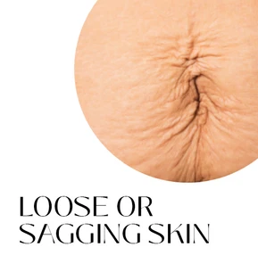 Body Tonic Medical Spa BBL Hero Loose Or Sagging Skin in Austin TX