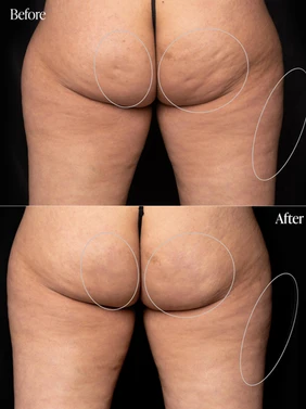 Body Tonic Medical Spa Clock Aveli Cellulite Treatment A In Austin, TX