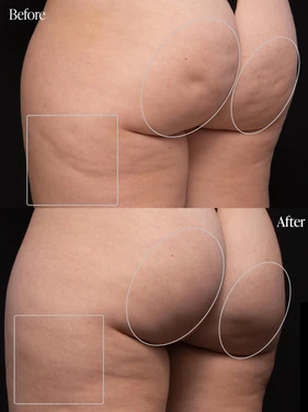 Body Tonic Medical Spa Clock Aveli Cellulite Treatment B In Austin, TX