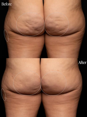 Body Tonic Medical Spa Clock Aveli Cellulite Treatment C In Austin, TX