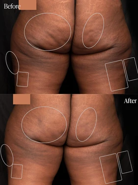 Body Tonic Medical Spa Clock Aveli Cellulite Treatment D In Austin, TX