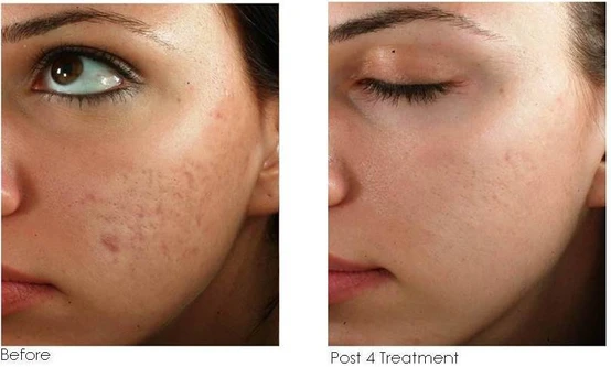 Body Tonic Medical Vampire Facial in Austin TX